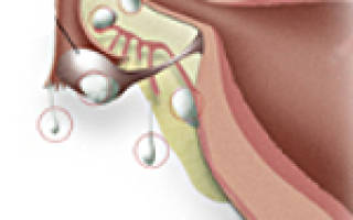 Киста или опухоль яичника — лечение в ЦЭЛТ. Фолликулярная и параовариальная киста