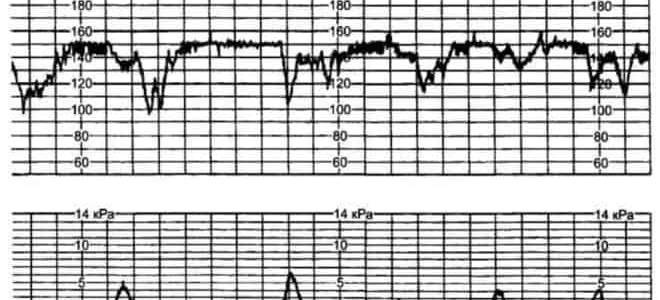 Брадикардия у плода на 36 неделе