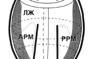 Нужна ли операция при сердечной недостаточности —