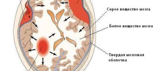 Гематома субдуральная на голове