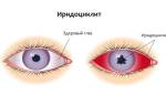 Иридоциклит, глазное заболевание — что это и как его лечить?