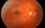 Ангиопатия сетчатки глаза у ребенка: что это такое, причины, лечение