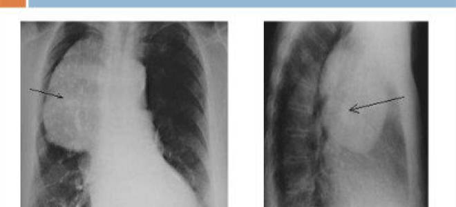 Виды злокачественных опухолей средостения – причины и симптомы рака средостения