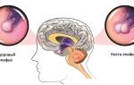 Киста шишковидной железы головного мозга: признки и лечение патологии эпифиза