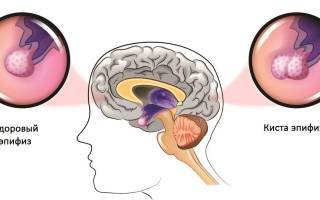 Киста шишковидной железы головного мозга: признки и лечение патологии эпифиза