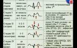 Критериями диагностики инфаркта миокарда являются