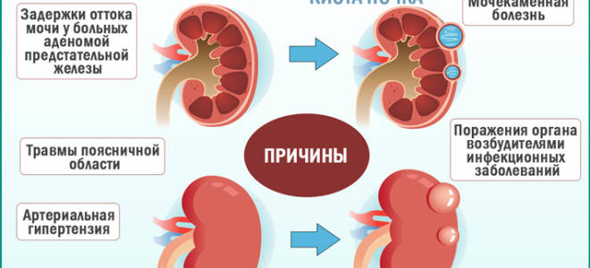 Паренхиматозная киста почки правой или левой: что это такое