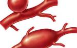 Что такое аневризма аорты брюшной полости
