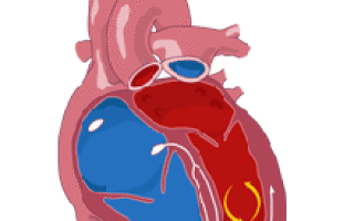 Фибрилляция желудочков сердца ⋆ Лечение Сердца