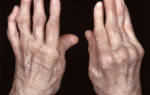 Ревматоидный артрит — Болезни ревматологии