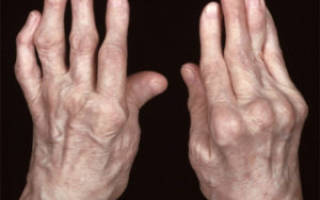 Ревматоидный артрит — Болезни ревматологии