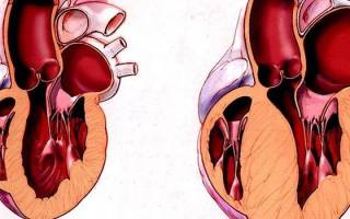 Гипертрофическая кардиомиопатия — причины и признаки, симптомы и лечение