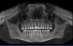 КТ расшифровка снимка зубов – что показывает ортопантомография