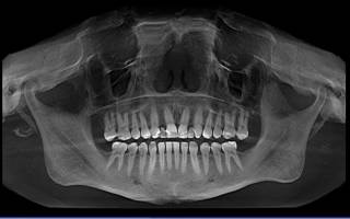 КТ расшифровка снимка зубов – что показывает ортопантомография