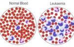 Острый лимфобластный лейкоз у взрослых прогноз