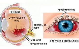 Кровоизлияние в глазу причины и лечение фото первый день