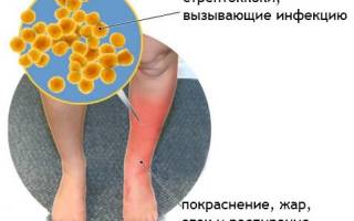Рожистое воспаление ноги симптомы
