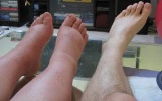 Отеки ног: почему отекают ноги, к какому врачу обращаться, боль при отеках