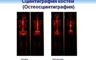 Сцинтиграфия костей остеосцинтиграфия что это такое и как делается