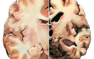Что такое атрофия головного мозга и как с ней бороться