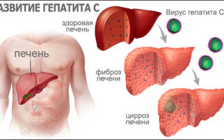Симптомы и лечение вирусного гепатита С