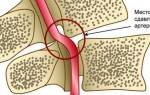 Экстравазальная компрессия позвоночной артерии — Твой суставчик