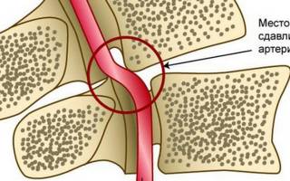 Экстравазальная компрессия позвоночной артерии — Твой суставчик