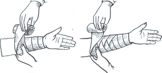 Растяжение предплечья лечение