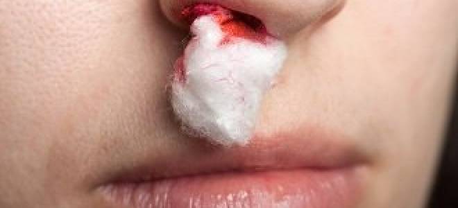 Кровотеча з носа