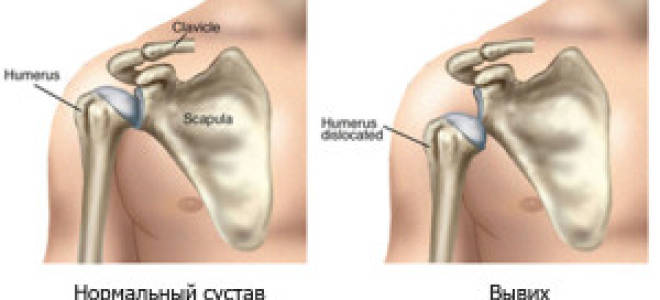 Первая помощь при вывихе плеча