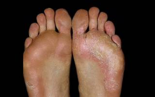 Лечение болезни ступней ног Современные способы лечения