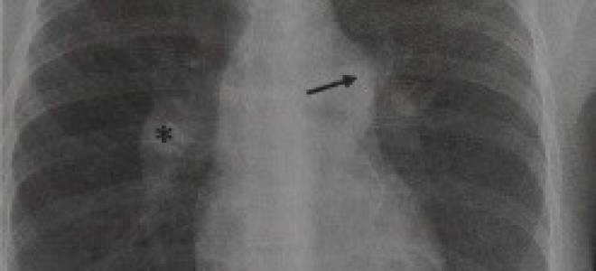 Рентгенологические признаки легочной гипертензии в легких
