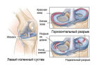 Разрыв мениска коленного сустава лечение