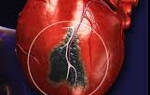 Инфаркт миокарда без обструкции коронарных артерий
