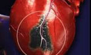 Общий осмотр при инфаркте миокарда