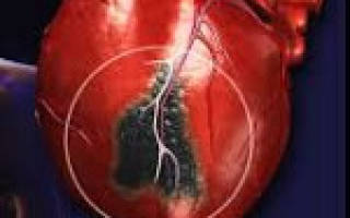 Инфаркт миокарда без обструкции коронарных артерий