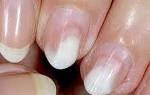 Причины и лечение онихолизиса отслоения ногтя от мягких тканей пальца