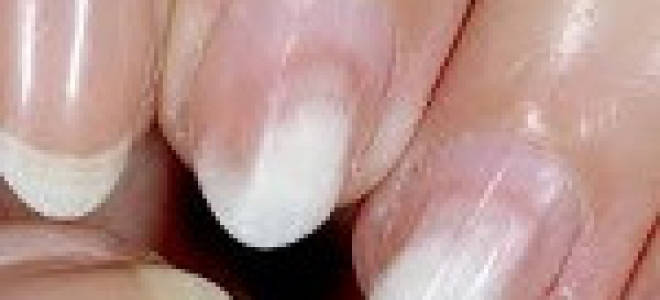 Причины и лечение онихолизиса отслоения ногтя от мягких тканей пальца