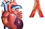 Инфаркт перенесенный на ногах последствия — Сердце