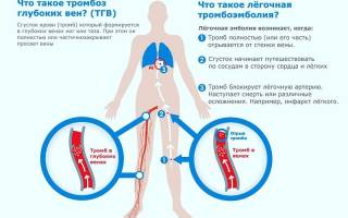 Тромб в легких: тромбоз легочной вены – симптомы и лечение