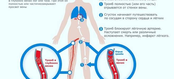 Тромб в легких: тромбоз легочной вены – симптомы и лечение