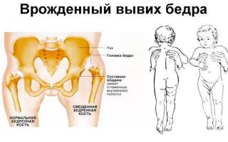 Вывих тазобедренного сустава у новорожденных