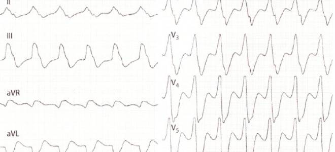 Экг желудочковая тахикардия экг фото