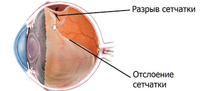 Макулярный разрыв сетчатки — симптомы и лечение