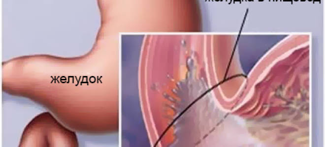 ГЭРБ – что это такое, симптомы и лечение болезни