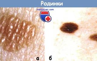 Что такое пигментный пограничный невус чем опасен и как лечится
