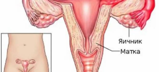 Чем лечить воспаление придатков у женщин
