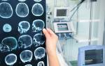 Симптомы и реабилитация после инсульта головного мозга