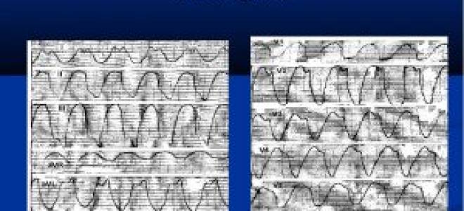 Признаки пароксизмальной желудочковой тахикардии