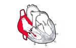 Гипертрофия правого предсердия сердца что это и как можно лечить